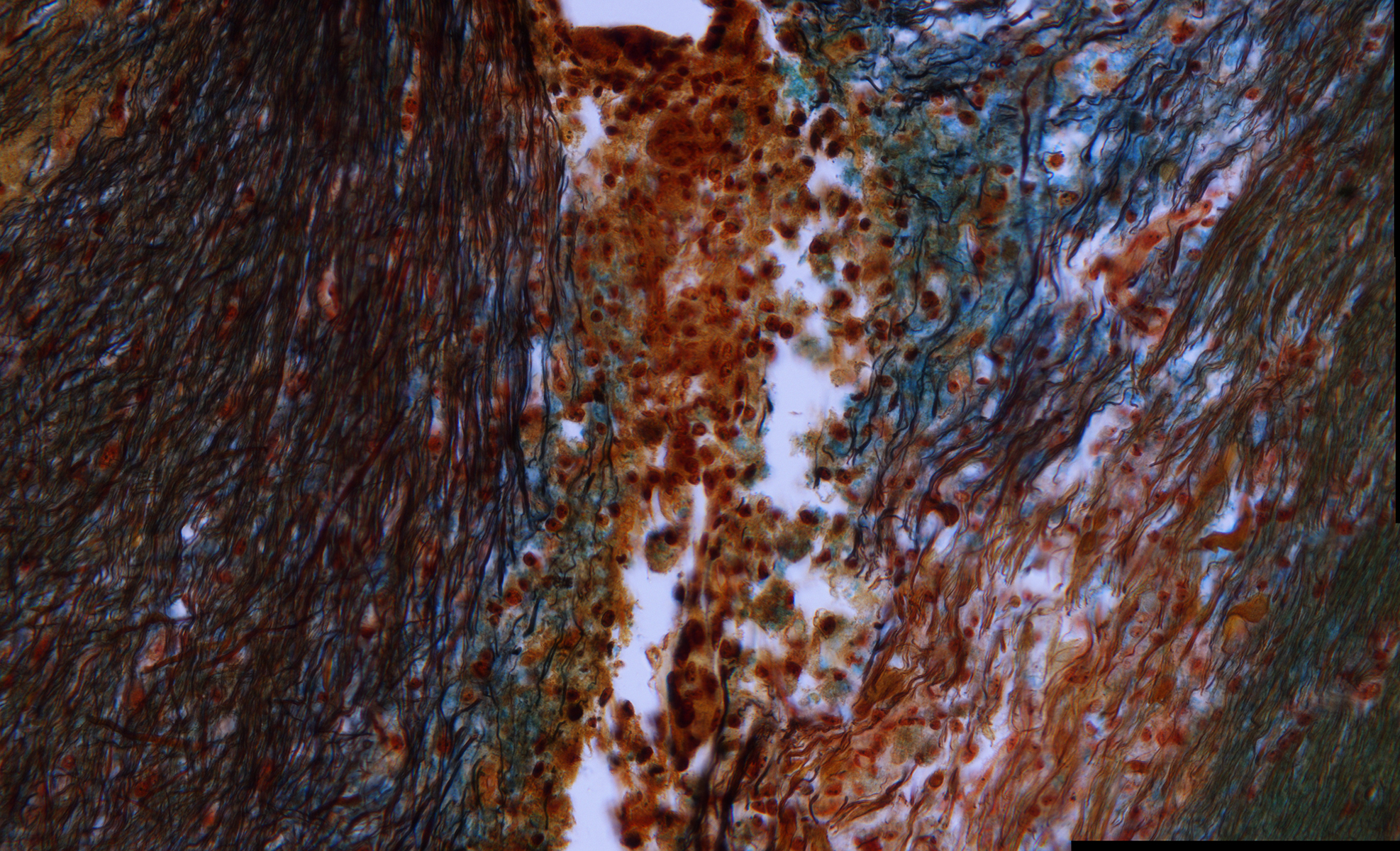 Brain - 59-422,12x40l remodeling of optic tract detail.jpg